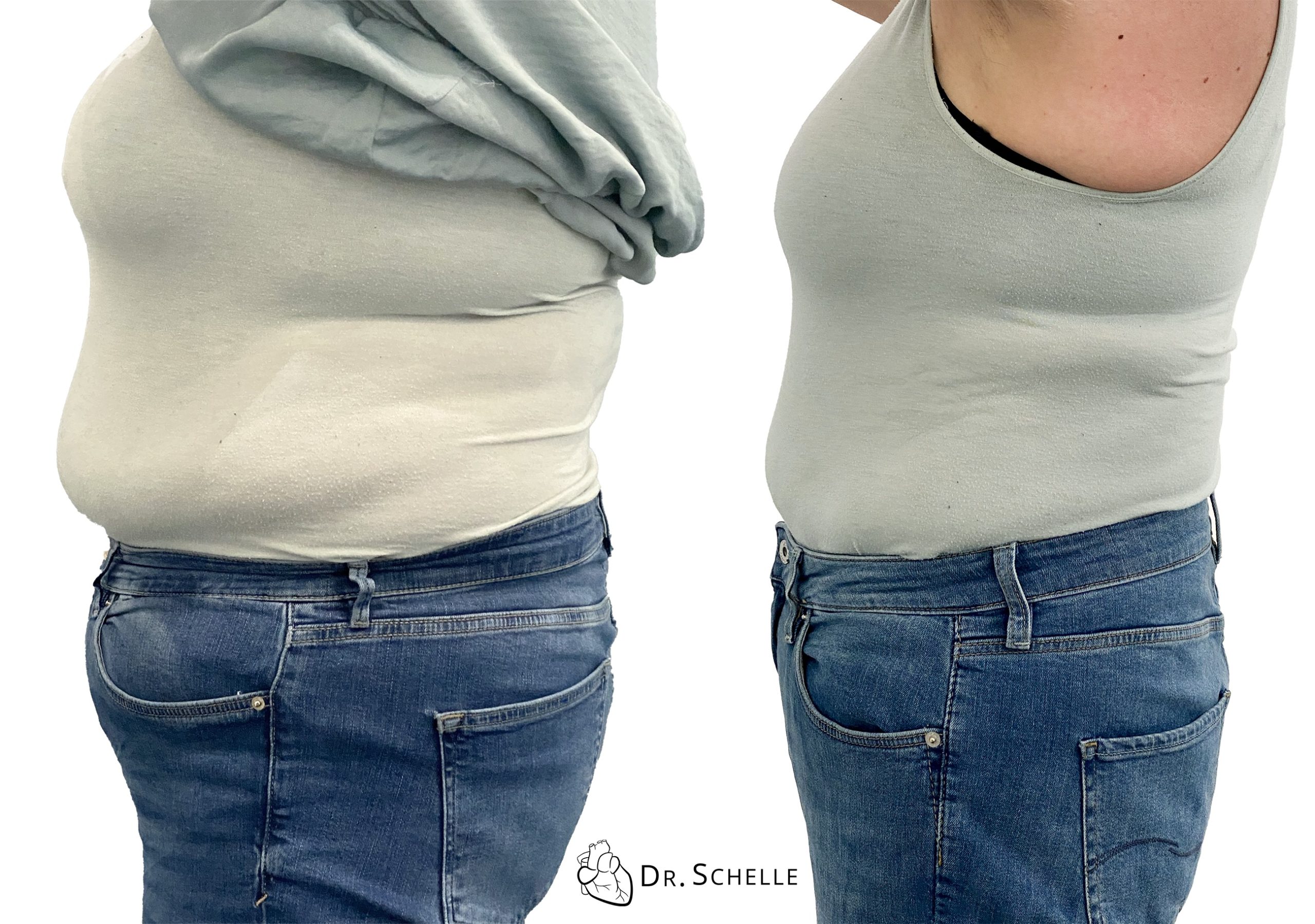 Vorher und Nachher, Bauchfett reduzieren, Abnehmen, Dr. Schelle, Leberfasten und Bodymed