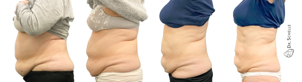 Abnehmen, Gewichtsabnahme, Vorher - Nachher Foto von der Seite, Bauchfett reduzieren, Bodytransformation 